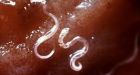 Boy, whose 22 litres blood was sucked by hookworms, cured